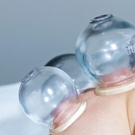 4_cupping-acupuncture350